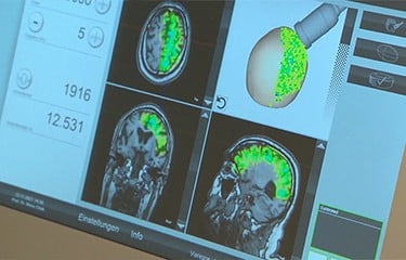 2Neurolith Transkranielle Pulsstimulation Alzheimer